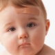 Shows an infant with a bandaid on his forehead