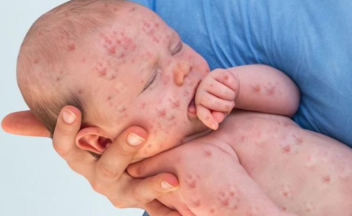 Shows a baby covered in measles being held by a nurse