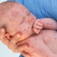 Shows a baby covered in measles being held by a nurse